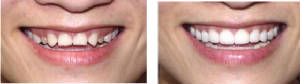 veneers.jpg.w300h84.jpg